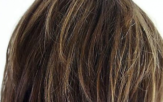 aankoop haarreconstructie